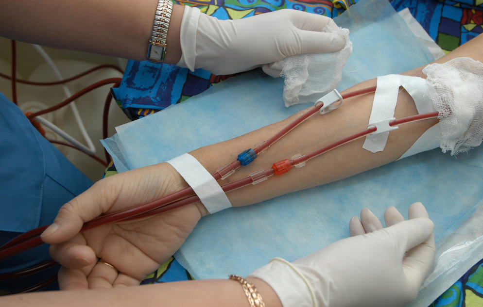 Photo of arm with tubes running from it, in the process of dialysis