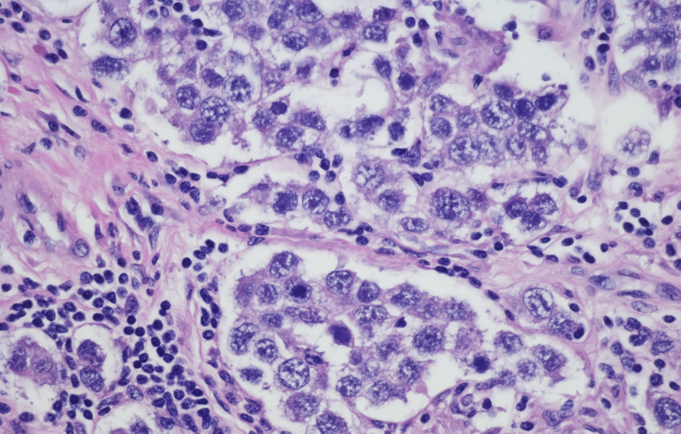 Micrograph of ovarian cancer cells