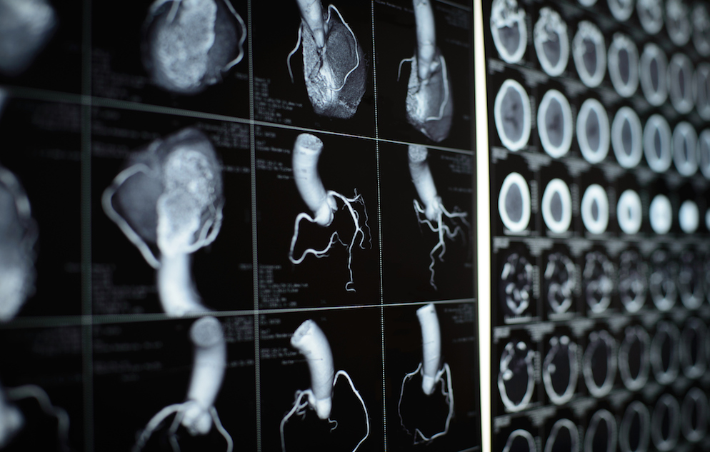 human heart and coronary artery CT images