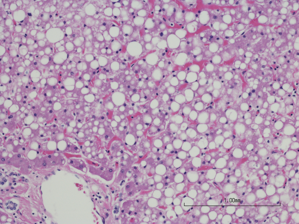 Macrovesicular hepatic steatosis of the liver (fatty liver disease)