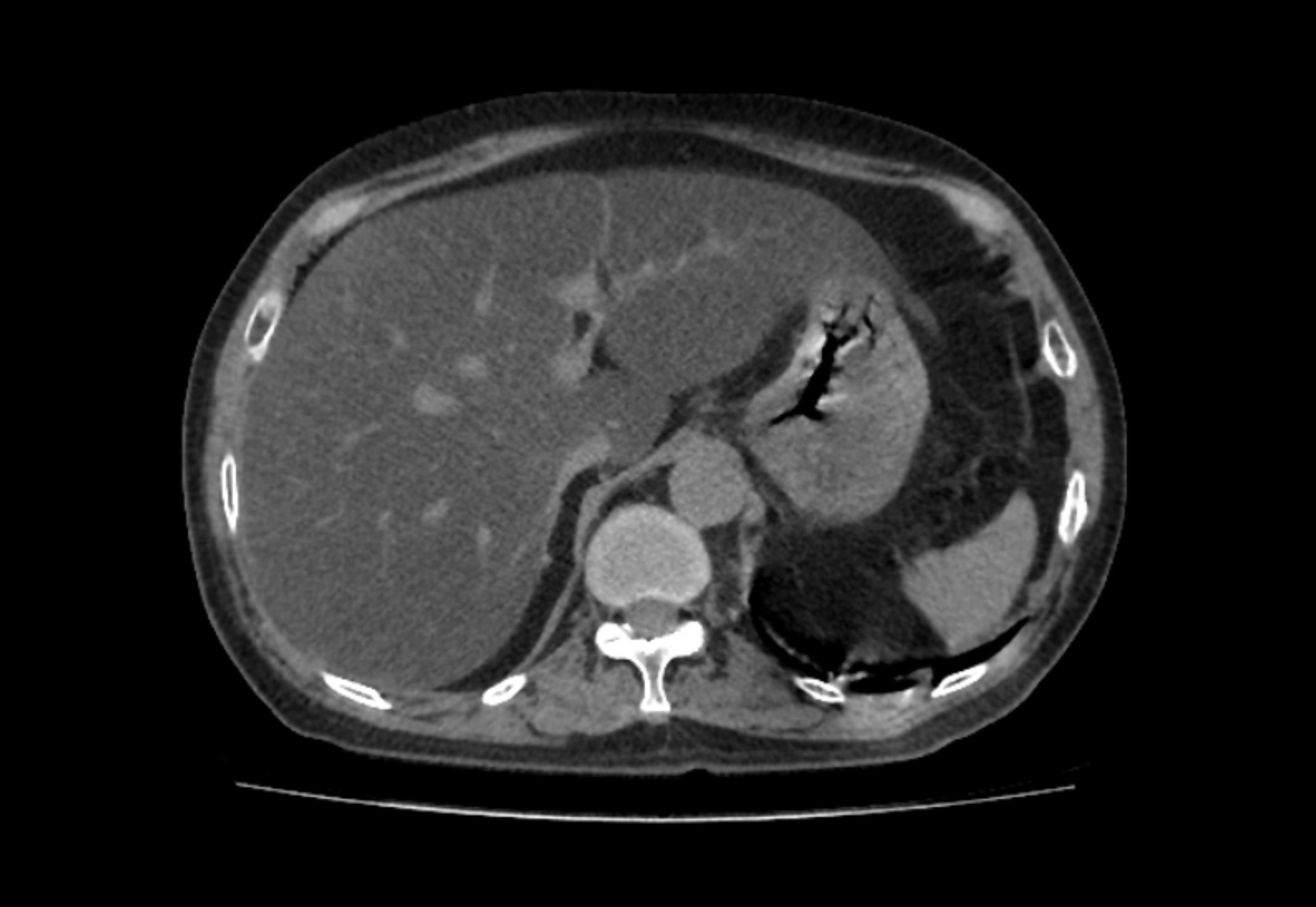 CT scan of fatty liver